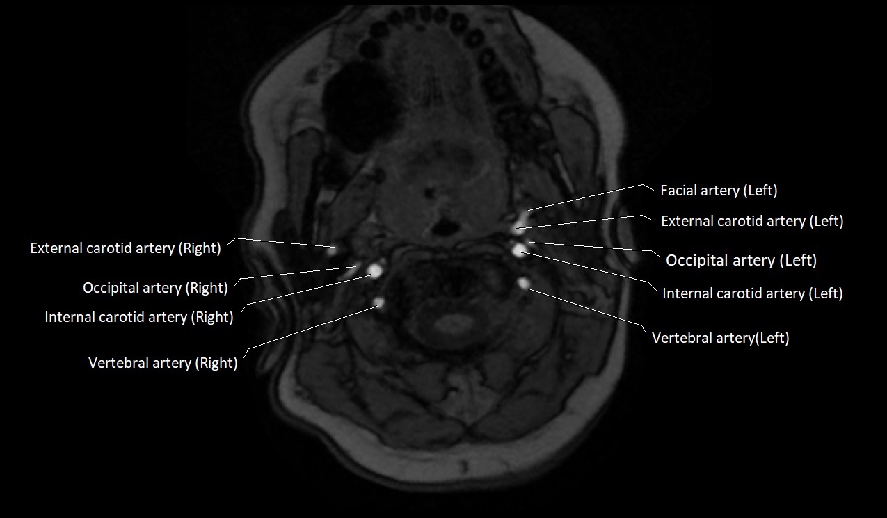 Carotid artery anatomy axial 3T image 15.jpg